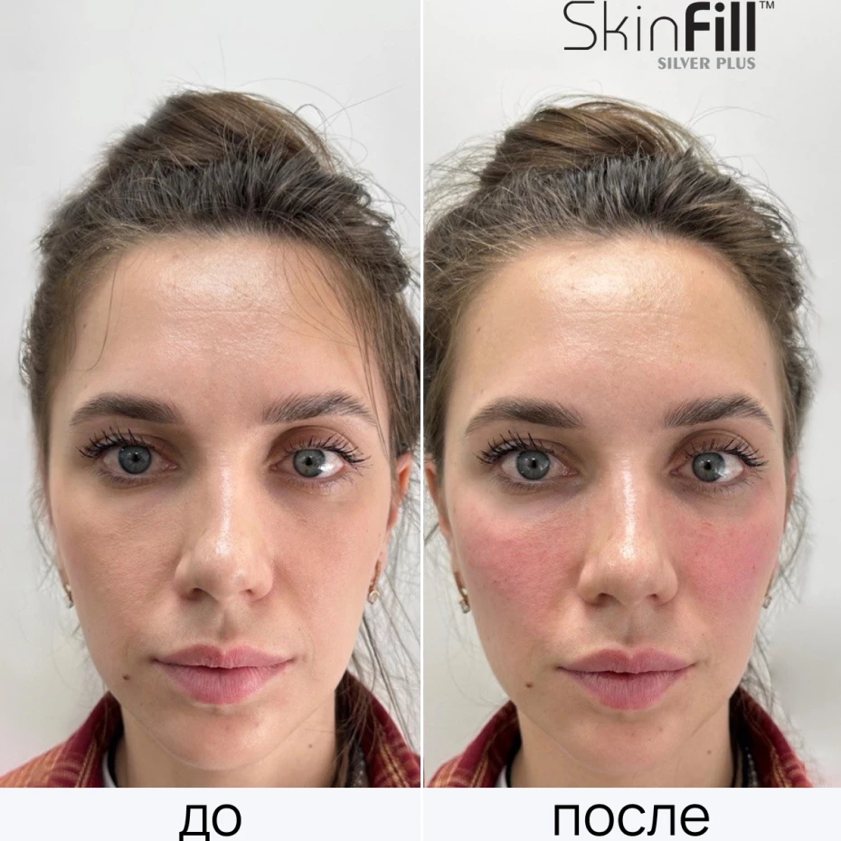 Дермальный филлер SkinFill Silver Plus (15 мг/мл)