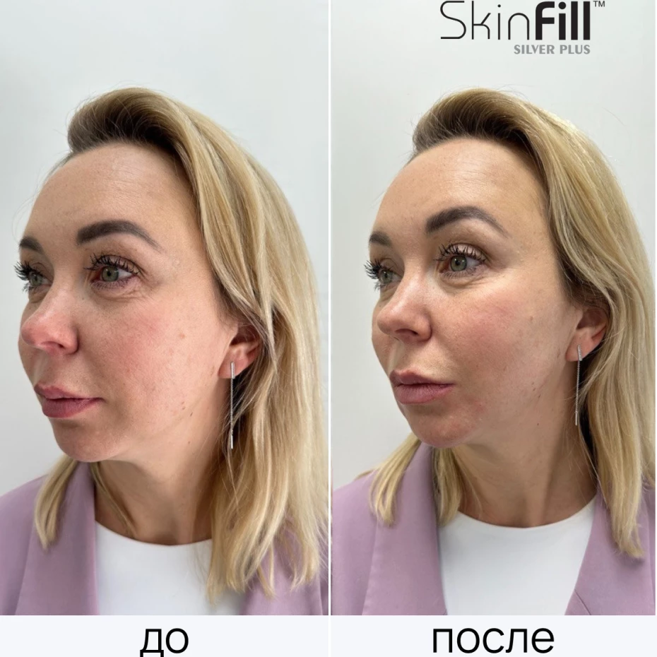Дермальный филлер SkinFill Silver Plus (15 мг/мл)