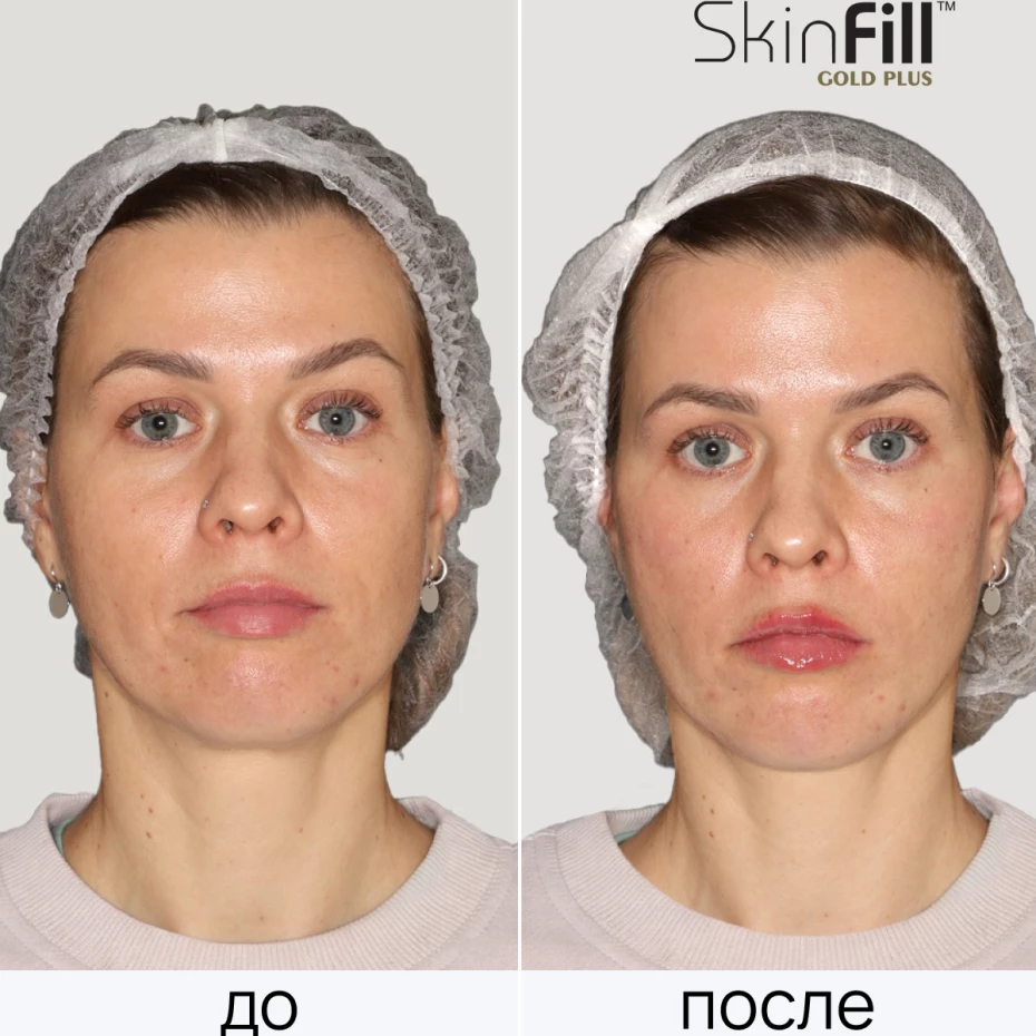 Дермальный филлер SkinFill Gold Plus (20 мг/мл)