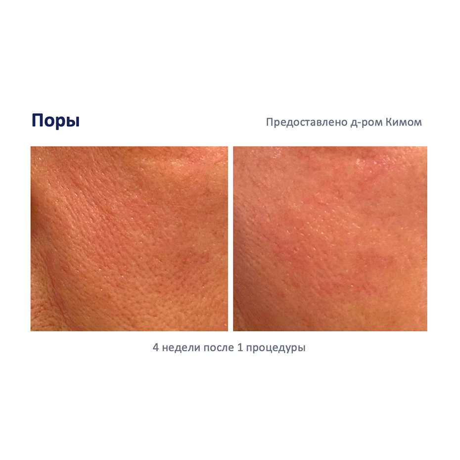 ДаблТайт (DoubleTite) Аппарат микроигольчатого RF