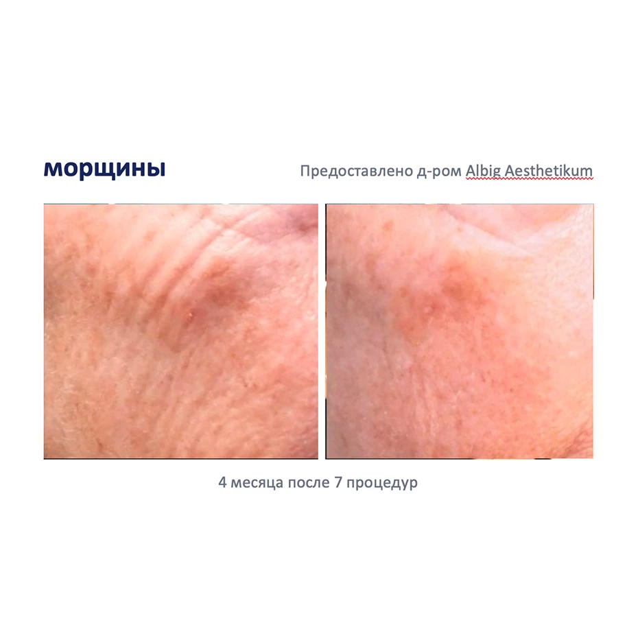ДаблТайт (DoubleTite) Аппарат микроигольчатого RF