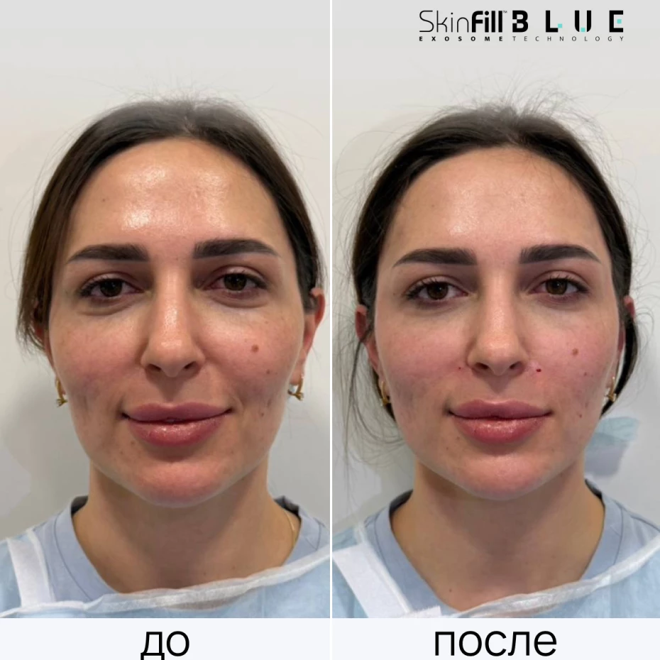 Экзобустер Blue