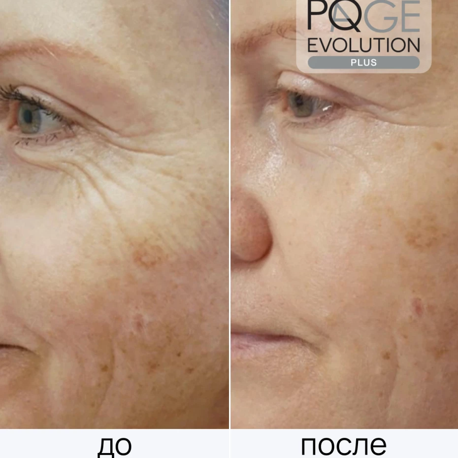 PQ Age Evolution Plus